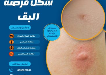 شكل قرصة البق