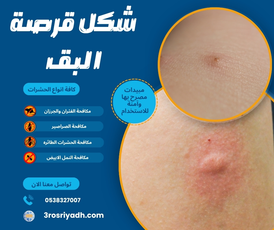 شكل قرصة البق